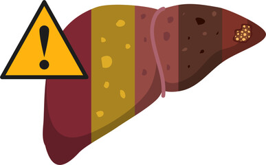 Liver disease illustration 