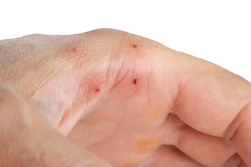 cat bite marks on hand, isolated