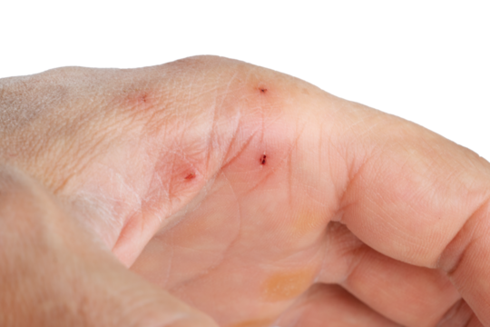 cat bite marks on hand, isolated