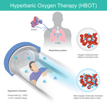 Hyperbaric Oxygen Therapy. A man has recumbent in tunnel glass for hyperbaric oxygen therapy pass by respiratory into blood vessel.
