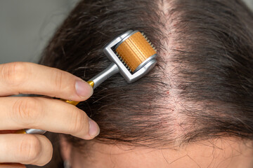 Close up view of young woman using microneedle derma roller on head for stimulating new hair growth...