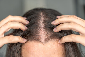Fototapeta premium Close-up view of the head with traces of blood from injections after mesotherapy, treatment of alopecia