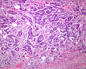 Obraz premium Human breast. Malignant carcinoma