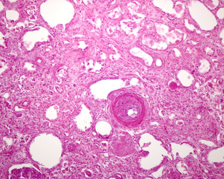 Human kidney. Nephrosclerosis