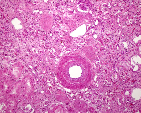 Human kidney. Nephrosclerosis