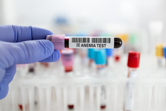 Doctor holding Sample of blood testing tube, to perform analysis of Anemia in blood of a patient samples isolated in laboratory background for analysis diagnosis