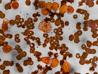 Chronic myeloid leukemia cells or CML, analyze by microscope. Blood cancer cells image.