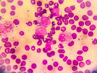 Chronic myeloid leukemia cells or CML, analyze by microscope. Blood cancer cells image.