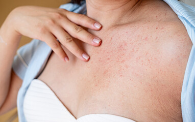 Skin irritation, allergy of a pregnant woman, red rash on the skin of the breast. Skin problem,...