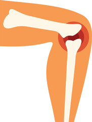 Illustration of a human leg with the skeleton showing, highlighting pain in the knee area