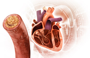 Cholesterol blocked artery with human heart. 3d illustration..