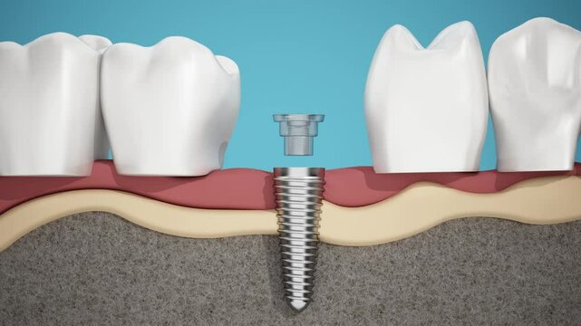 3D animation of a tooth implant procedure viewed from front view