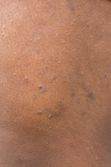 Eczema on brown skin, atopic dermatitis and prurigo nodularis on brown skin leg, eczema breakout on dark skin