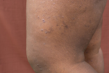 Eczema on brown skin, atopic dermatitis and prurigo nodularis on brown skin leg, eczema breakout on...