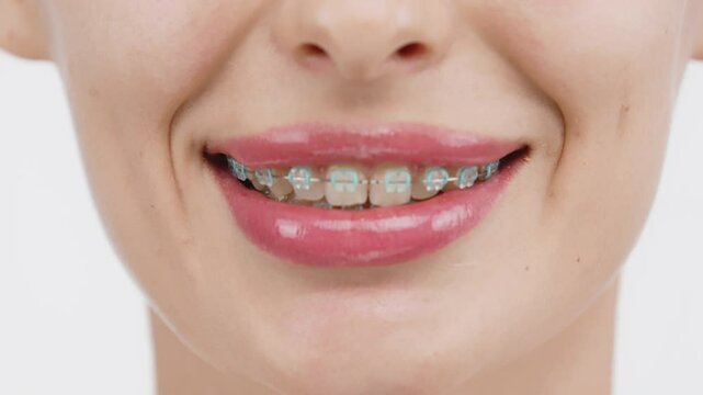 A close-up of a woman's teeth with full lips and braces. She smiles, showcasing her commitment to oral hygiene and confidence in her smile.