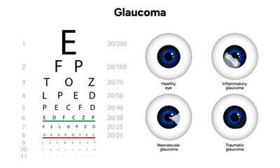 Healthy eye and eye with glaucoma. Ophthalmology eye examination. Inflammatory glaucoma. Neovascular glaucoma. Traumatic glaucoma