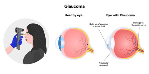 Ophthalmology eye testing. Pneumotonometer. Eye anatomy