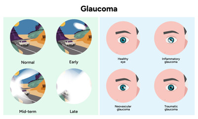 Healthy eye and eye with glaucoma. Inflammatory glaucoma. Neovascular glaucoma. Traumatic glaucoma. Early, mid-term and late glaucoma