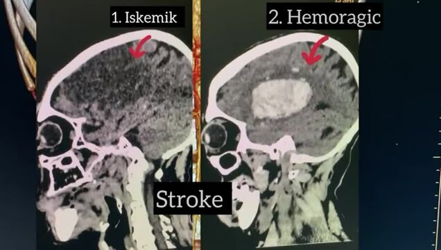 Head Brain CT scan of ischemic stroke and hemorrhagic case in Radiology