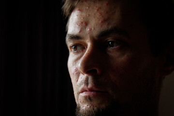 Sick sad man portrait, adult chickenpox.