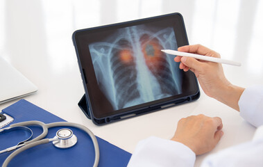 lung cancer pneumonia lung emphysema concept. doctor explaining results of lung check up by x-ray chest image on digital tablet screen to patient.