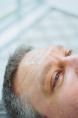 A beautician makes a mask on a man's face in a spa salon. Side view of male face during procedure. Pimples and acne on the skin. Injection for a man's face