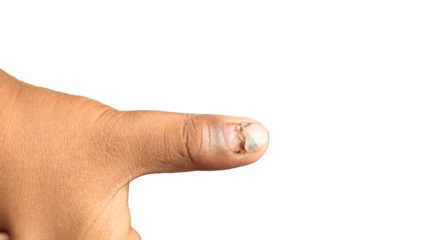 hand with Thumb finger injured