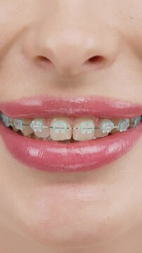 Vertical video. A close-up of a woman's teeth with full lips and braces. She smiles, showcasing her commitment to oral hygiene and confidence in her smile.