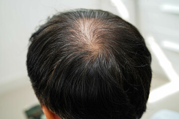 Bald head in man, hair loss treatment health problem.