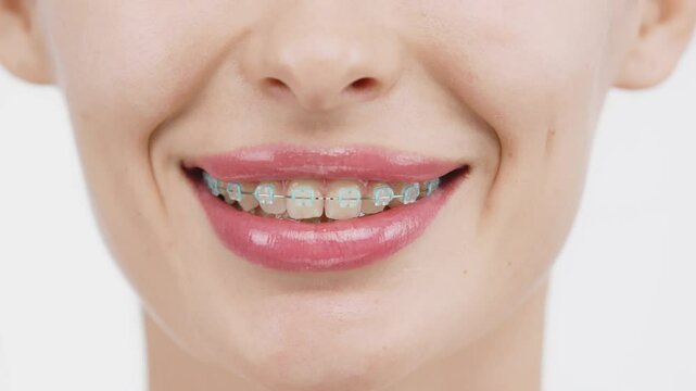 A close-up of a woman's teeth with full lips and braces. She smiles, showcasing her commitment to oral hygiene and confidence in her smile.