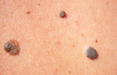 Nevus close-up. Mole on human skin. Irregular birthmark.
