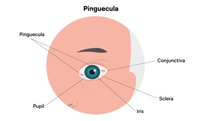 Fototapeta premium Pinguecula yellow spots in eye. Ophthalmology problem
