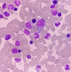 Bone marrow study, microscopically show increased megakaryocytes and all stage of maturation....