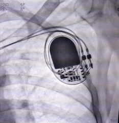 X ray image showed dual chamber permanent pacemaker (PPM) in left chest at Cath Laboratory.