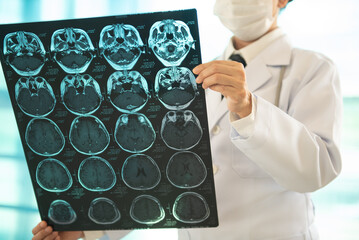 Doctor looking film brain x-ray image for diagnose ischemic stroke or cerebrovascular disease.