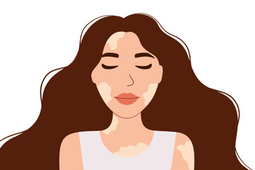 Beautiful woman with vitiligo skin. Body positivity and self acceptance. Skin condition, vector illustration