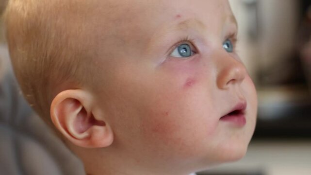 Infection on the face caused by insect, mosquito or bee bites that causes swelling, redness, heat and itching. Allergy after mosquito bites. FullHD footage.