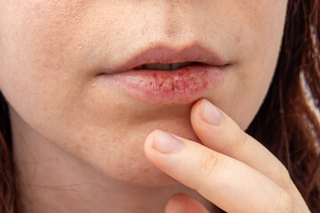 Dry skin on face and dry chapped lips. Cracked female lips