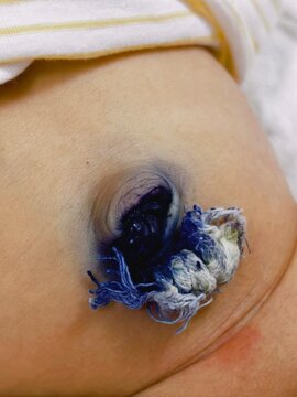 Selective focus on navel or umbilical cord on belly of newborn baby. Vertical photo. no face