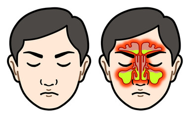 副鼻腔炎（男性）