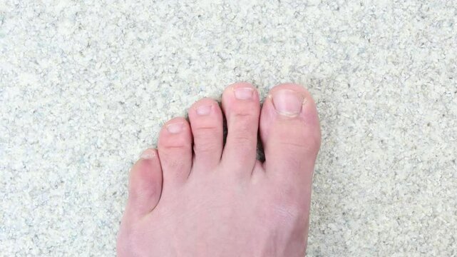 Stubbed toe top down view, injured pinky toe
