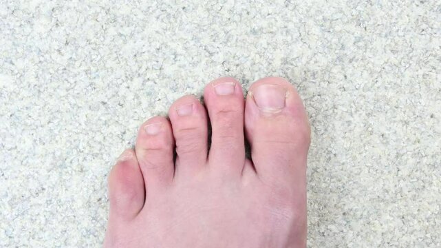 Swollen pinky toe, broken toe injury