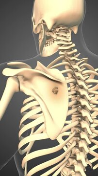 Cancer spreading along a scapula bone