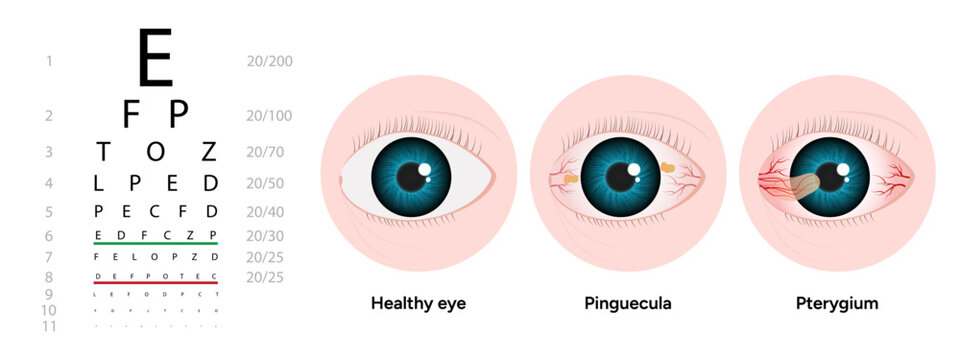Optometry appointment healthy eye pinguecula and pterygium