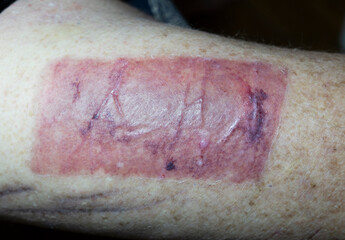 Skin graft donor site on the thigh of a senior male having surgery for a skin cancer.