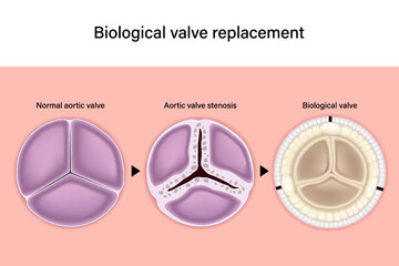 Aortic valve replacement. Normal aortic valve. Aortic valve stenosis. Biological valve. Aortic valve repair. 