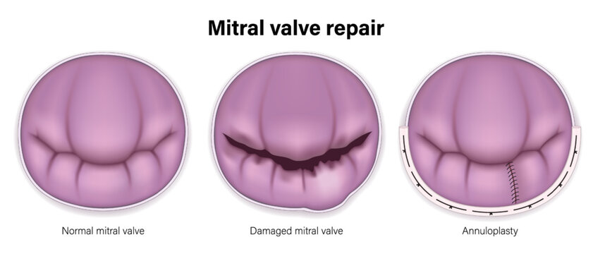 Mitral valve repair vector. Normal mitral valve, Damaged mitral valve and Annuloplasty.