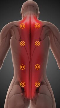 Myofascial pain syndrome or chronic pain disorder