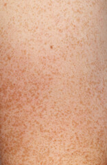 A person's arm has a patch of red skin