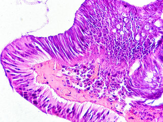 Histological analysis of gastric polyp showing villous adenoma with high grade dysplasia. Gastric...